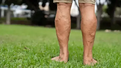 How Much Does Varicose Vein Surgery Cost?